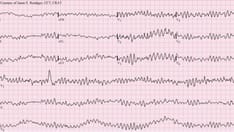 Acute Complications of Myocardial Infarction