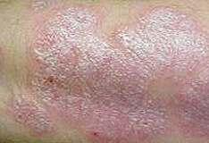 Fototar, Medotar (coal tar topical) dosing, indications ...