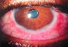 Patanase (olopatadine intranasal) dosing, indications 