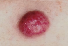 Progress in Rare Cancers Is ASCO Advance of the Year