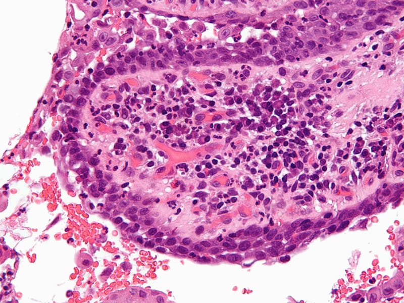 Guidelines for the Management of Pemphigus Vulgaris 2017