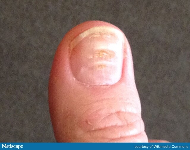 Nailing Nail Pathology Primary Care Case Challenge Page 4