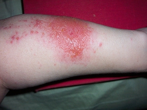 Common Causes of Pediatric Allergic Contact Dermatitis