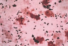 strep group treatment b skin Overview, Human of the Herpesvirus Mouth: Infections Viral