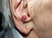 Immunotherapy Should Be First Line In Merkel Cell Carcinoma