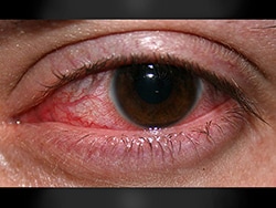 High-Dose Steroids: Worth the Risk in Bacterial Keratitis?