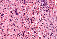 Discoid Lupus Erythematosus Background Etiology Epidemiology