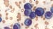 FDA Warns of Higher Death Risk With Pepaxto in Multiple Myeloma
