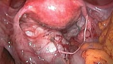 Lesions in Pelvis May Be 'Tip of the Iceberg' in Endometriosis