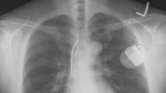 Cardiac Device Interrogation After Death 'Richly Informative'
