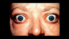 Even Inactive Thyroid Eye Disease Adversely Impacts Patients