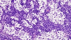 De-escalation Strategy in Seminoma: An Alternative Option?