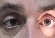 Isolated Abducens Nerve Palsy With Hyperhomocysteinemia