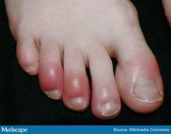 COVID Toes', 'Kawasaki' Rash: 5 Cutaneous Signs in COVID-19