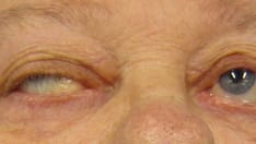 Two Investigational Meds Promising for Myasthenia Gravis