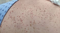 Avapritinib Promising for Systemic Mastocytosis Treatment