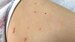 Diagnosing Molluscum Contagiosum Can Be Tricky