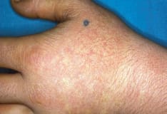 Cutaneous Porphyria Practice Essentials Pathophysiology Epidemiology