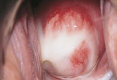 A condyloma acuminatum tünetei, kezelése és megelőzése, Kúp alakú szemölcsök