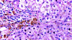 Common Genetic Disorder Tied to Increased Dementia Risk in Men