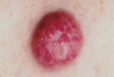 multifocal florid papillomatosis sucuri detox