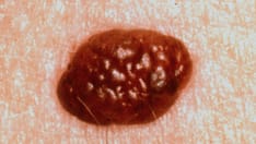 When Is MRI Useful in the Management of Congenital Melanocytic Nevi?