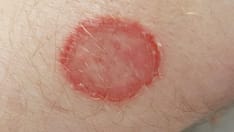 Emerging Invasive Fungal Infections Call for Better Records