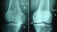 NSAIDs for Knee Osteoarthritis May Worsen Pain Over Time