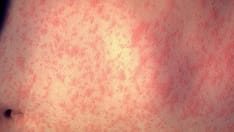 CDC Urges International Travelers to Get Measles Vaccine