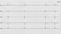 Minimizing Atrial Pacing No Benefit in Sinus Node Disease: DANPACE II