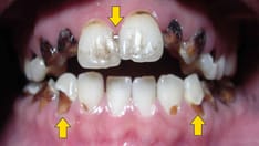 Clues in the Oral Cavity: Are You Missing the Diagnosis?
