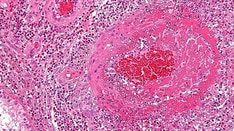 Benralizumab Proves Noninferior to Mepolizumab for EGPA