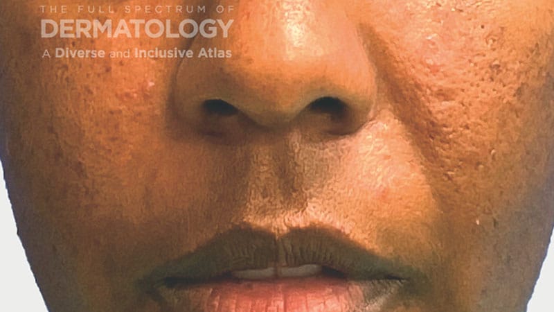 Rosacea in Dark Skin Types: Not Rare, but Underdiagnosed