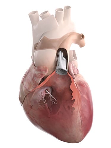The AUTUS valve recently won FDA approval.