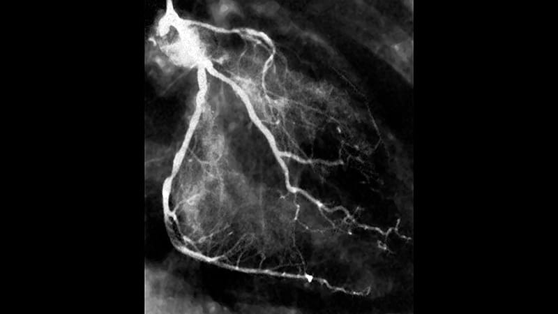 Sequencing of TAVI Before PCI Found to be Noninferior
