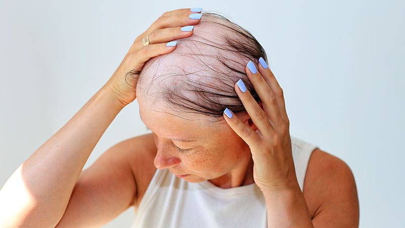 Consensus Statement for Alopecia Areata Identifies JAK Inhibitors as First-Line Therapy