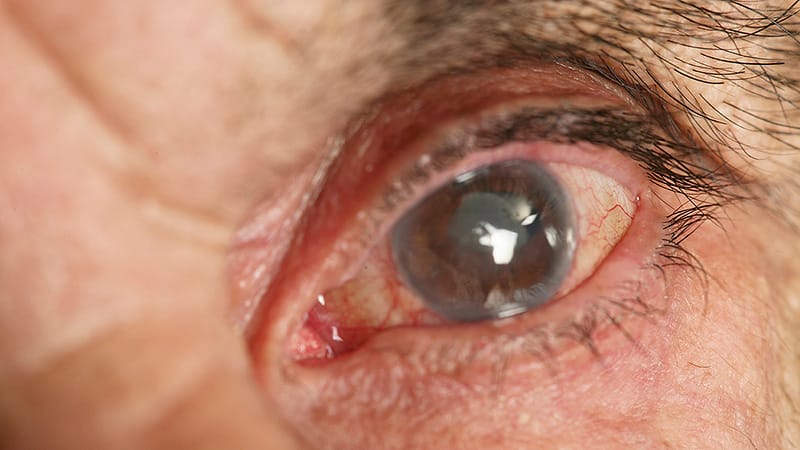 Same-Day Cataract Surgery in Both Eyes: Safe, With Caveats