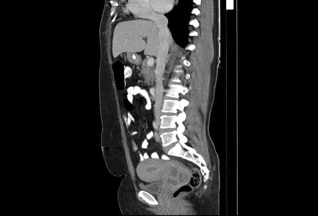 Diagnosis and Treatment of Cervical Cancer