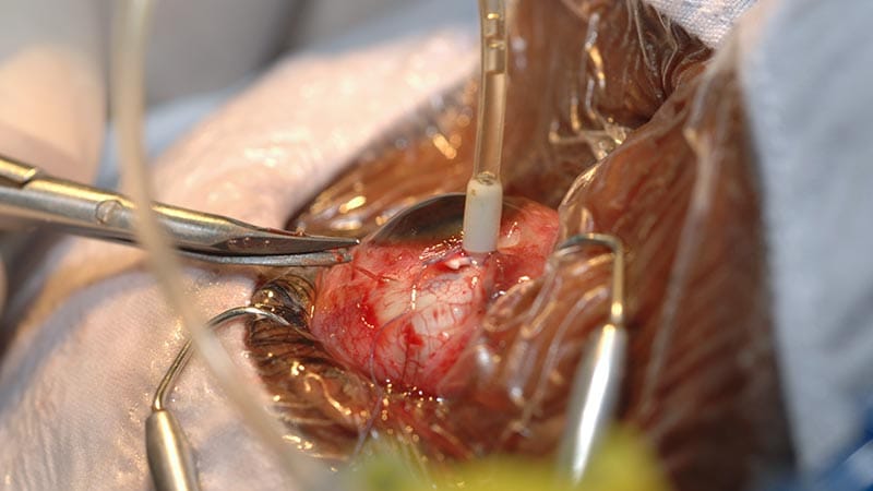 Study Supports In-Office Retinal Surgeries, but How Complex?