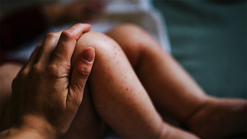 Ubicación del eczema infantil relacionada con el riesgo de alergia alimentaria