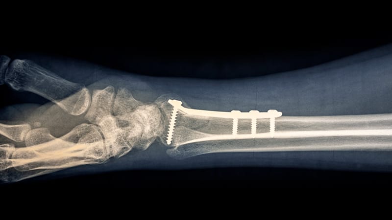 Infection Rare After Distal Radius Fracture Surgery