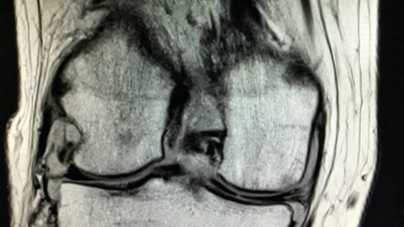 Infraclinical Synovitis: What You Need to Know