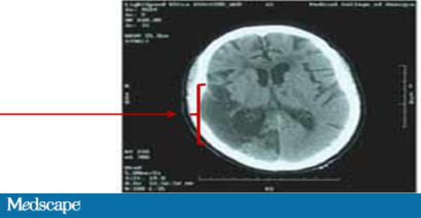 Headache, Limp, and Projectile Vomiting in a 5-Year-Old