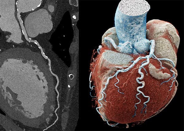 Photon-counting computed tomography (PCCT) of the heart.
