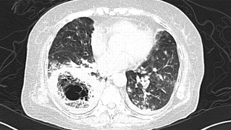 New Assay Aids Diagnosis of Invasive Aspergillosis