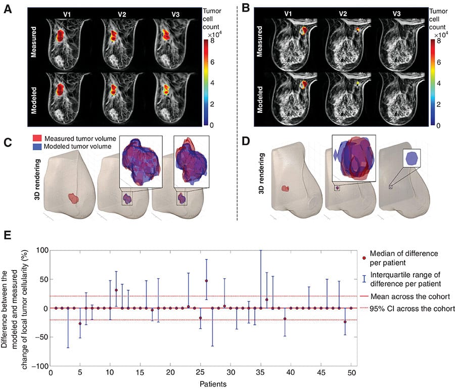 A patient's real tumor (top row) compared with what the computational model predicted 