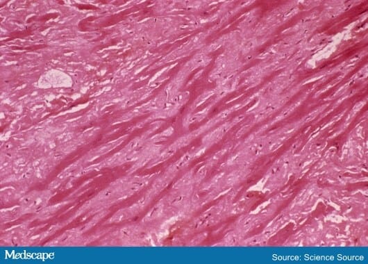 Hattr Fast Five Quiz: Presentation/Diagnosis of hATTR