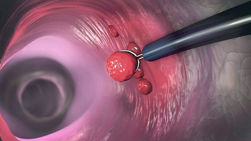 Fast Five Quiz: Colonoscopy Bowel Prep