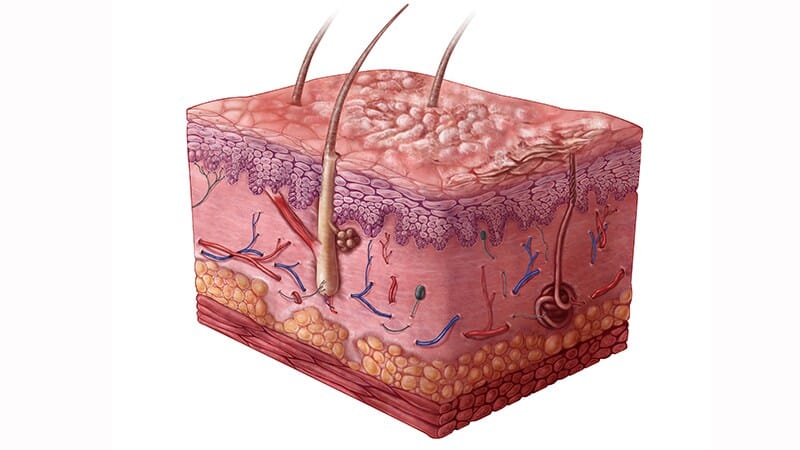 Fast Five Quiz: Severe Psoriasis
