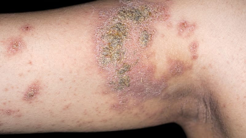Fast Five Quiz: Atopic Dermatitis